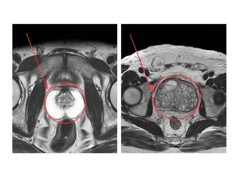 Verglach vun enger gesonder (lénks) an entzündlecher (riets) Prostata op MRI Biller